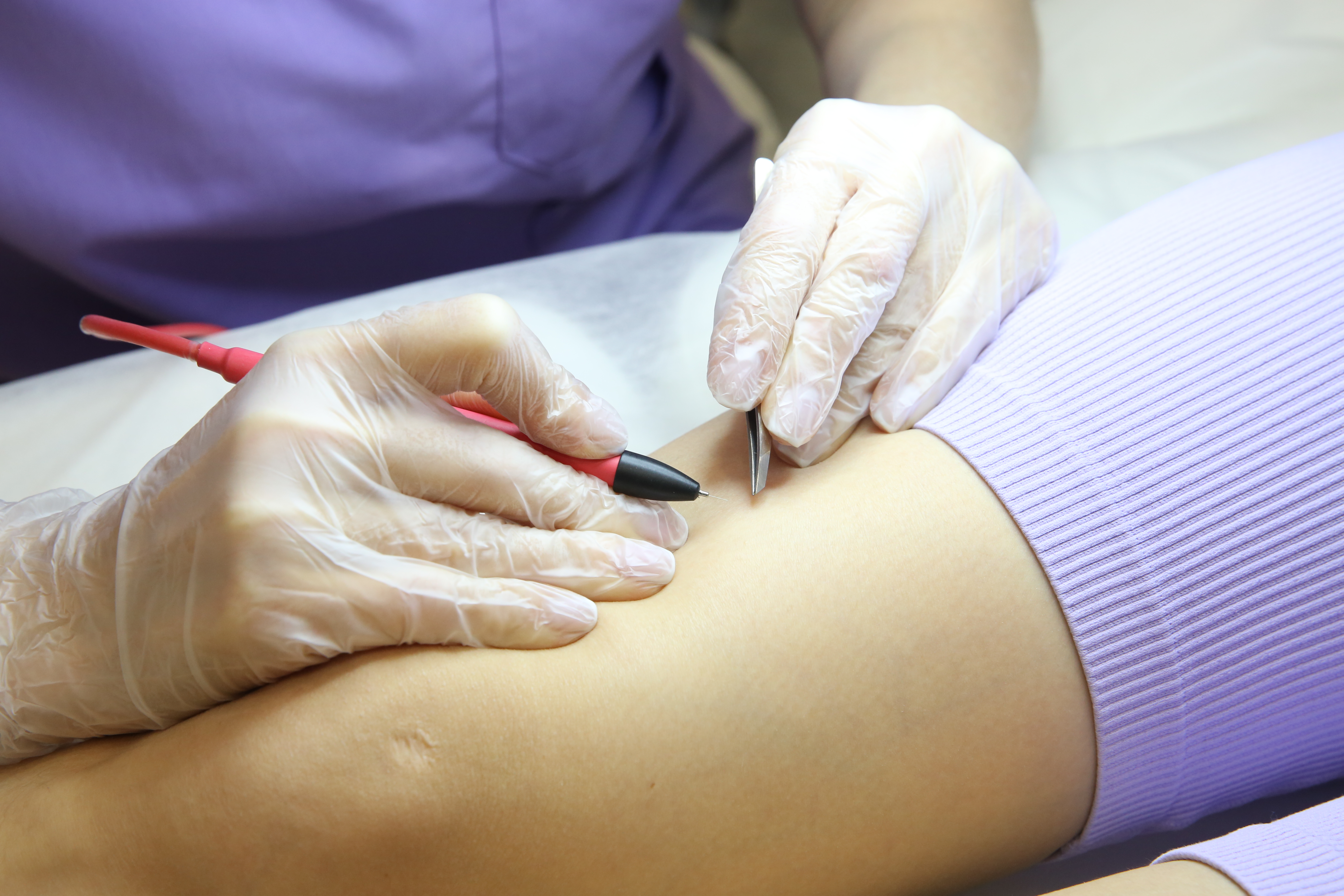 Электроэпиляция